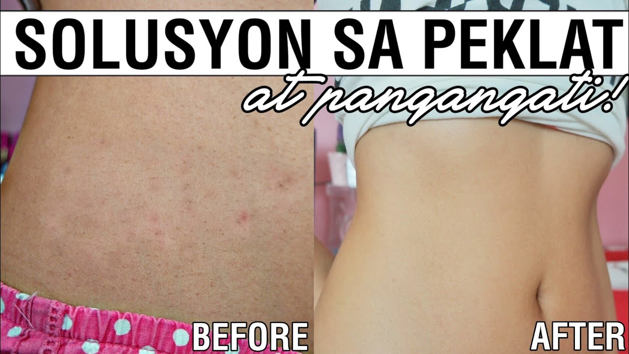 MAITIM NA PEKLAT, Matatanggal pa ba? Paano maiiwasan? Alamin! - Martha Jante 🐚