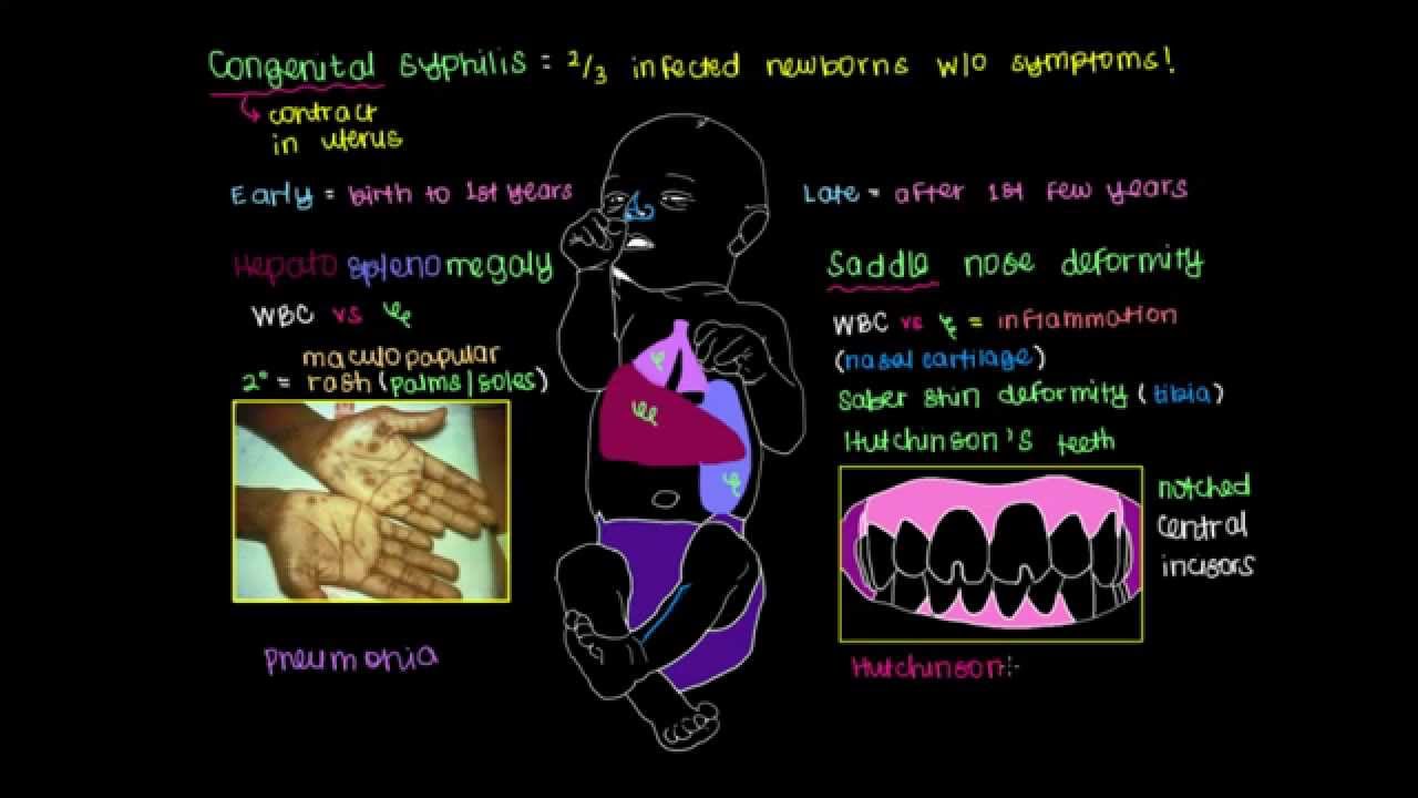 What is Congenital Syphilis?