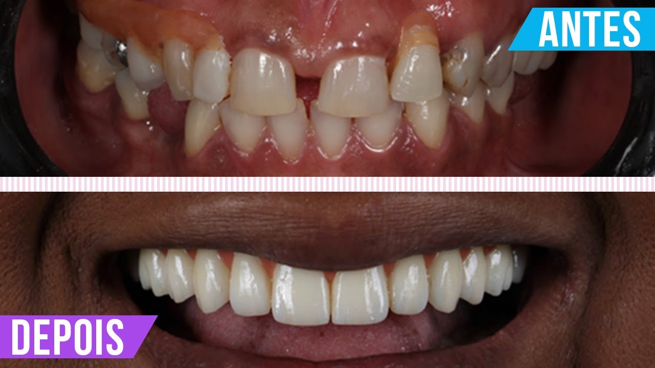 IMPLANTE DENTÁRIO: ANTES E DEPOIS DA CIRURGIA