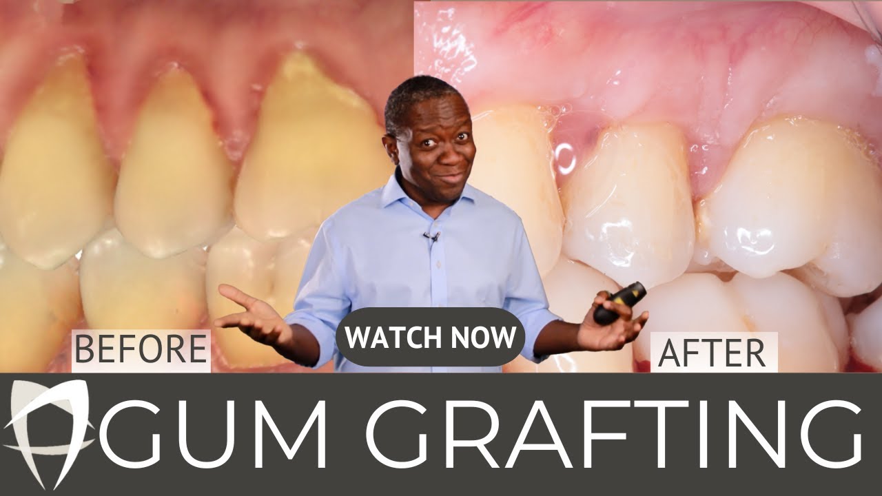 Gum Grafting Explained (2024): Receding Gums No More! (Before & After)