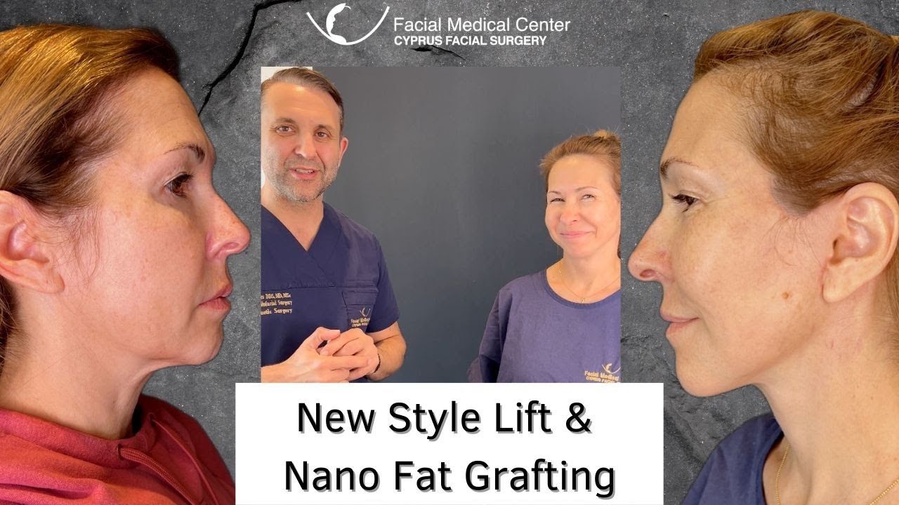 New Style Lift Facelift & Nano Fat Grafting |Cyprus Facial Surgery
