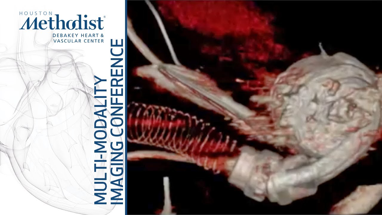 Imaging the Patient with LVAD: From Bedside to Echo to CTA (Kassi, MD, Chang, MD) February 8, 2022