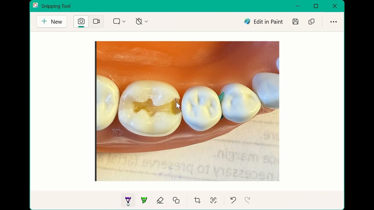 Mastering ADEX Criteria: Proximal Contact, Gingival Clearance, and Axial Wall Depth | ADEX Exam Tips