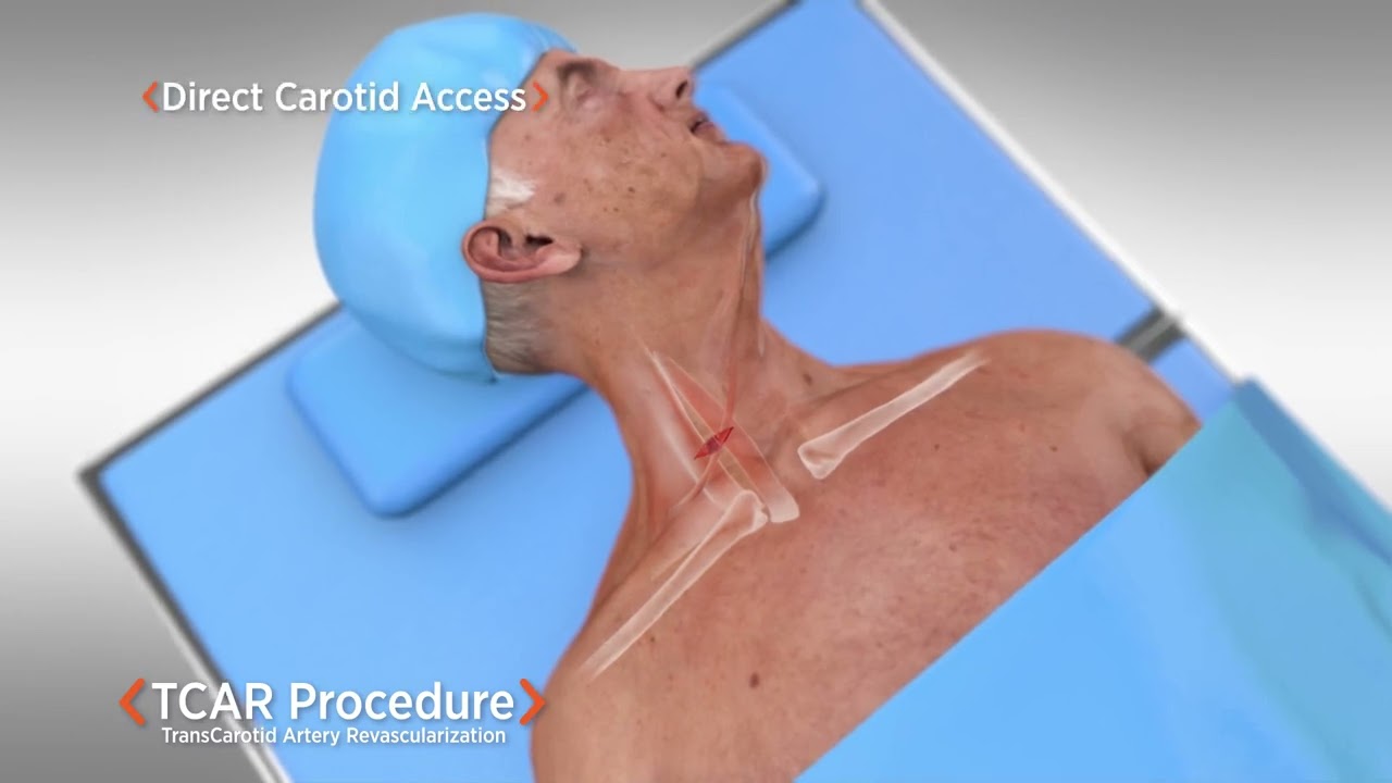Carotid Stenting TCAR