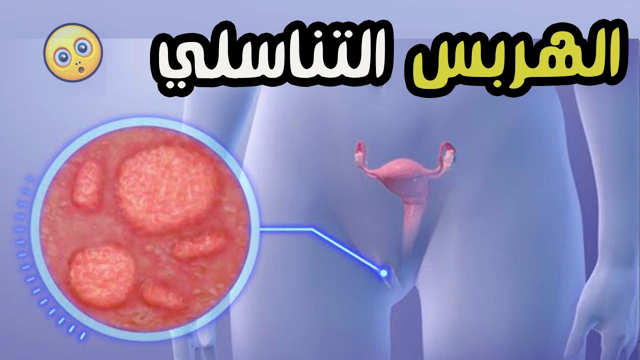 الهربس التناسلي عند النساء… العدوى الصامتة التي تهدد حياتك الحميمية!