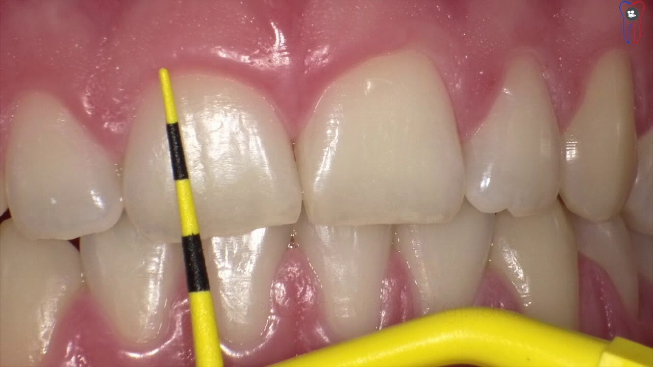L'apport du laser diode lors des finitions orthodontique (JO2018)