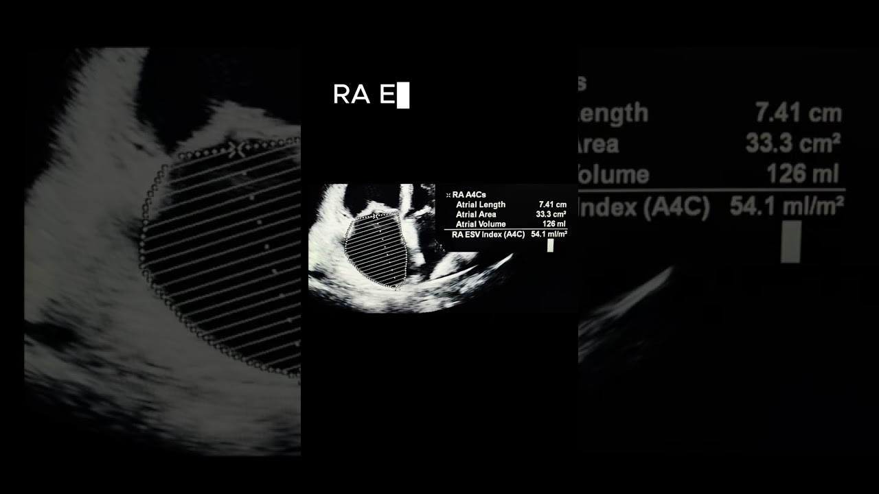 Cor Pulmonale Key Echo Findings ☝🏽