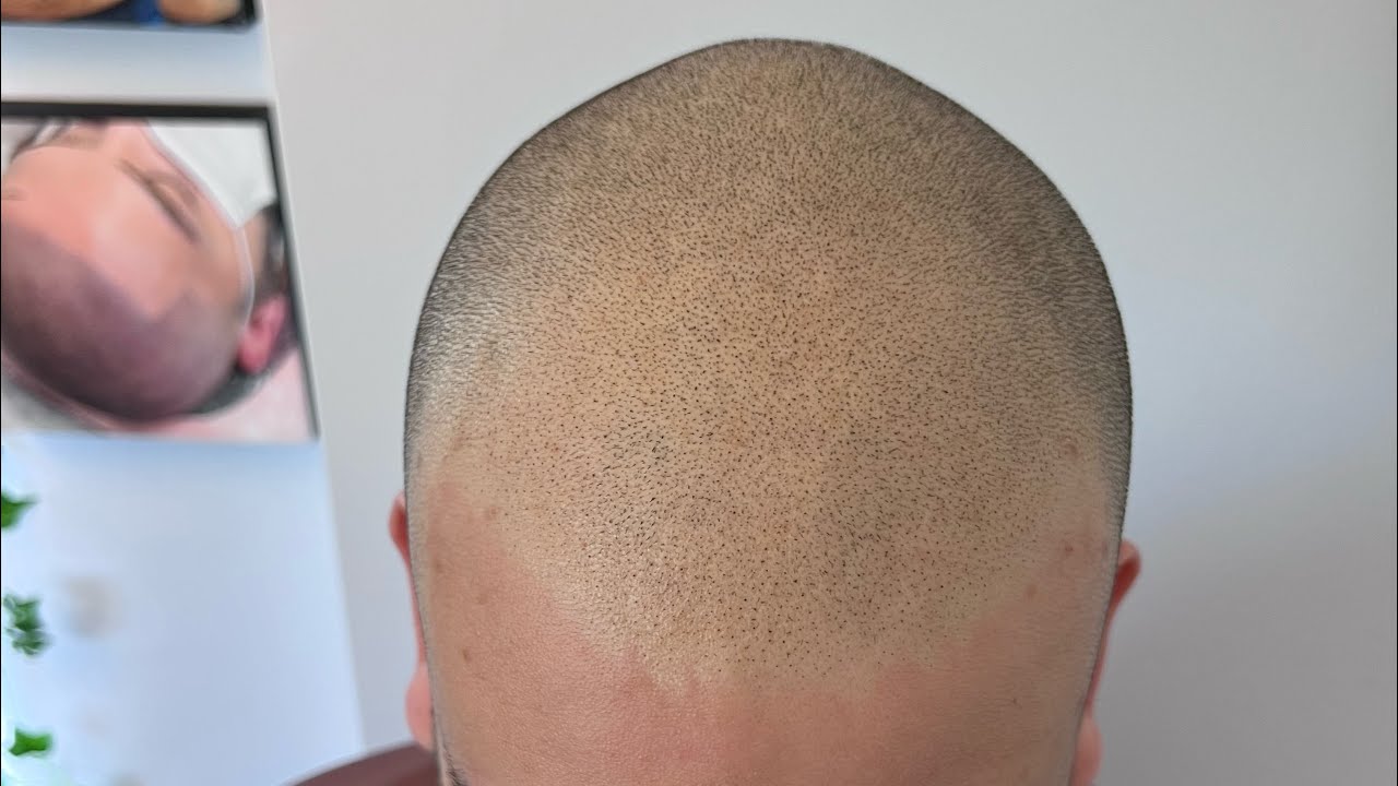 Scalp Micropigmentation Artist Donna Fathi in Vancouver @flawlessscalpmicropigmentation SMP