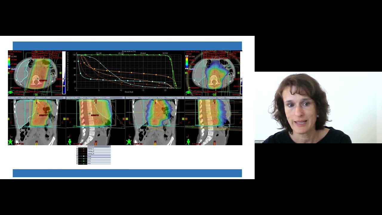 SIOP 2021 - Radiotherapy dose and target and Neuroblastoma palliation