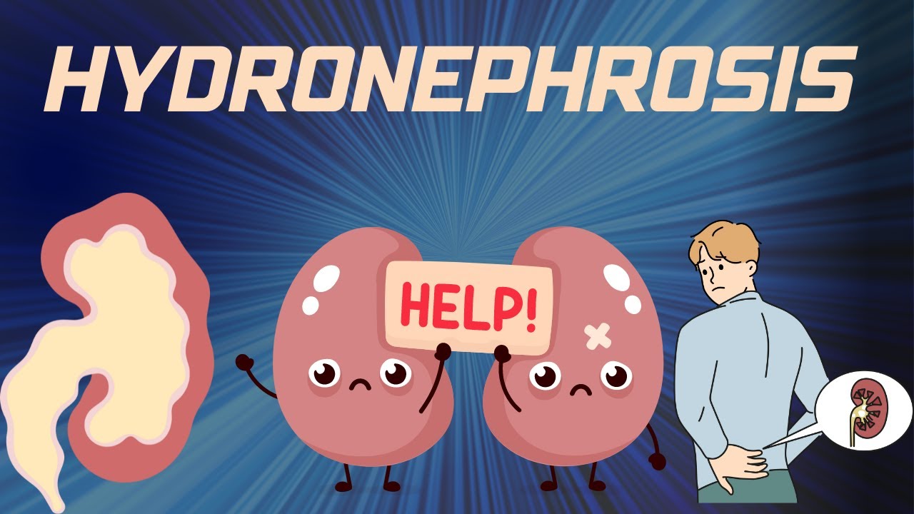 HYDRONEPHROSIS : Pathophysiology, Causes, signs and symptoms, background, diagnosis and treatment