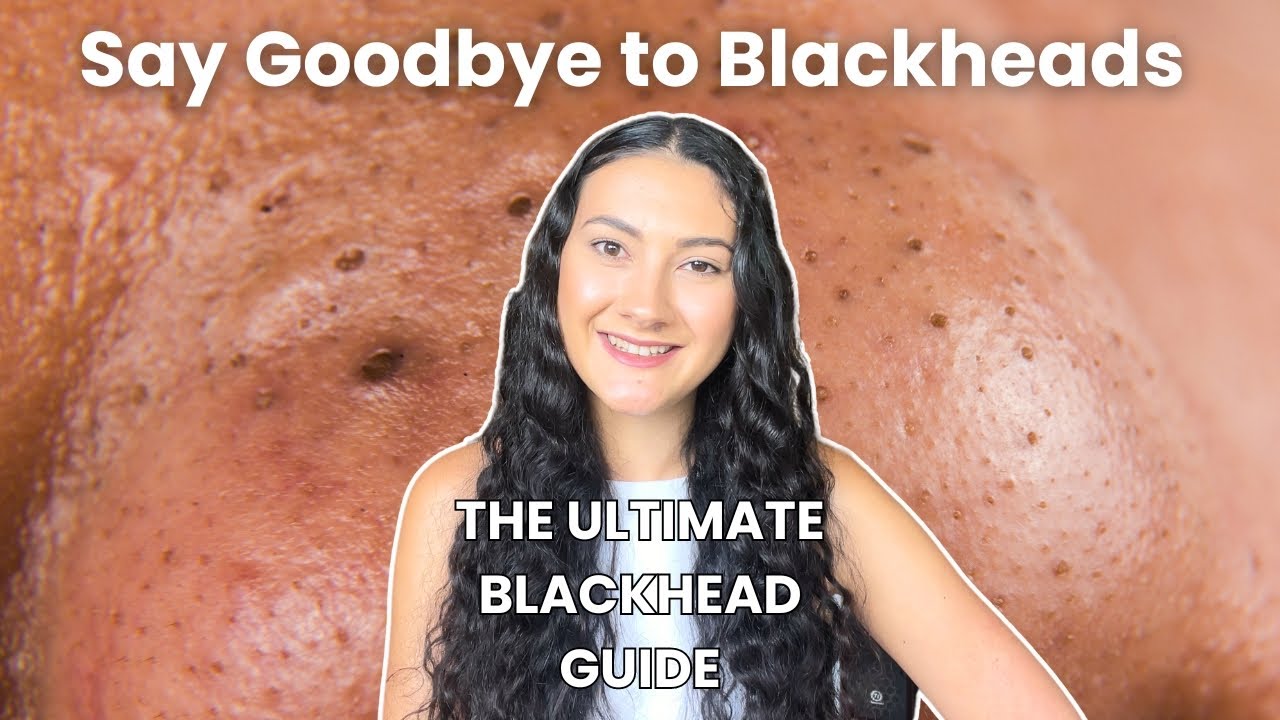 Here's How To CONQUER Blackheads