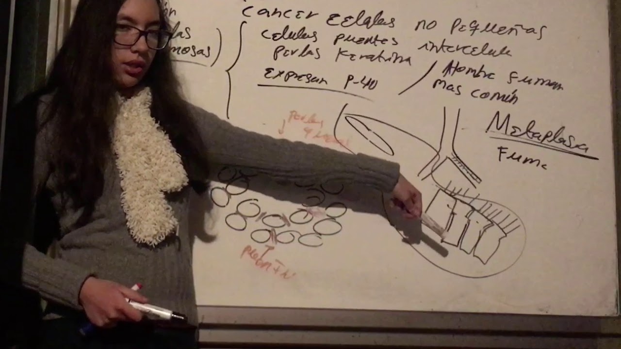 Carcinoma Células Escamosas. Cancer Pulmonar.  Patología Tracto Respiratorio
