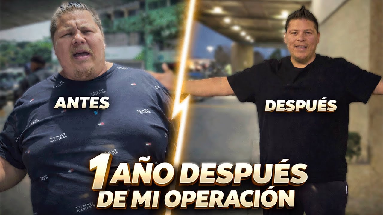 😀ASI ESTOY DESPUES DE UN AÑO DE MI OPERACION😃 