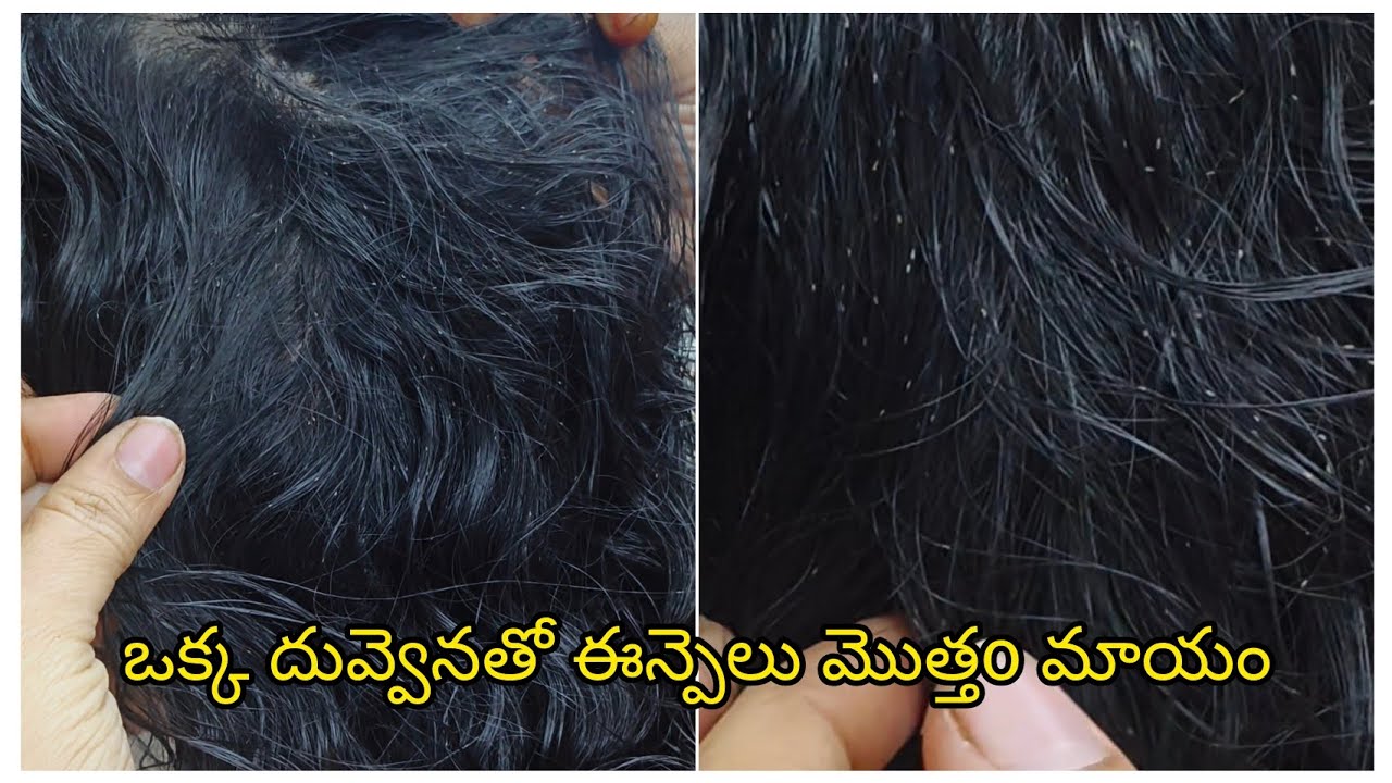  మీ పిల్లల తలలో కూడా పేలు & ఈన్పెలు ఉన్నాయా..ఏమి చేసిన పోవడo లేద!!అయితే ఈ వీడియో చూడండి don't miss..