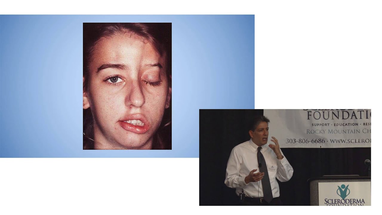 Scleroderma 101-Dr. Michael Thakor