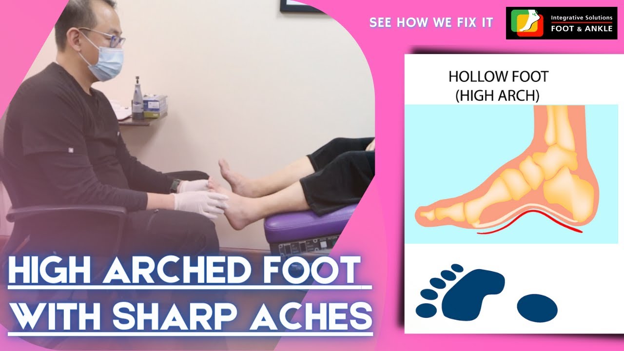 High Arched Foot with Sharp Aches  | Manhattan Foot Specialist | Dr Lee Foot