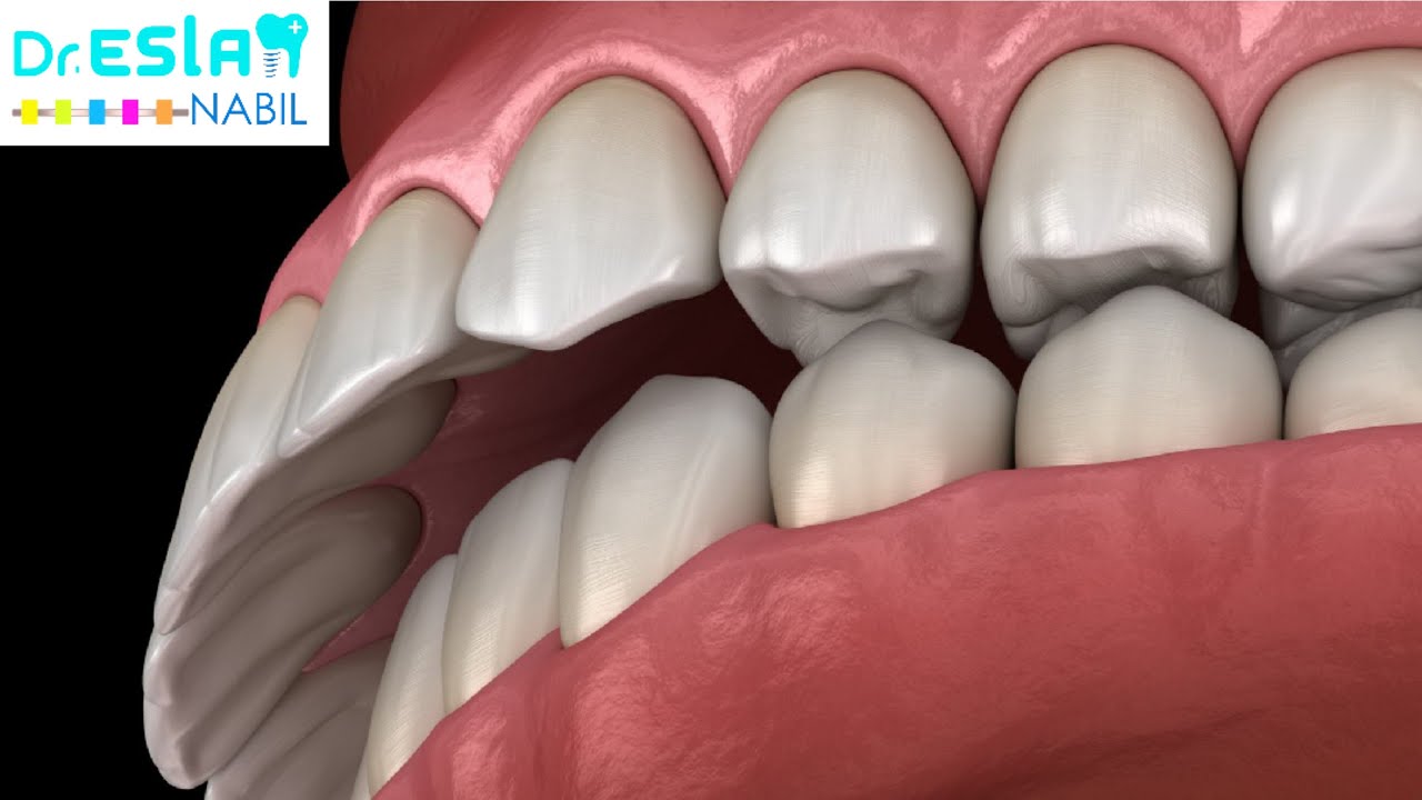 ضب الفك العلوي - ما هي تفاصيل المشكلة وتفاصيل العلاج #دكتور_اسلام_نبيل #دكتور_تقويم
