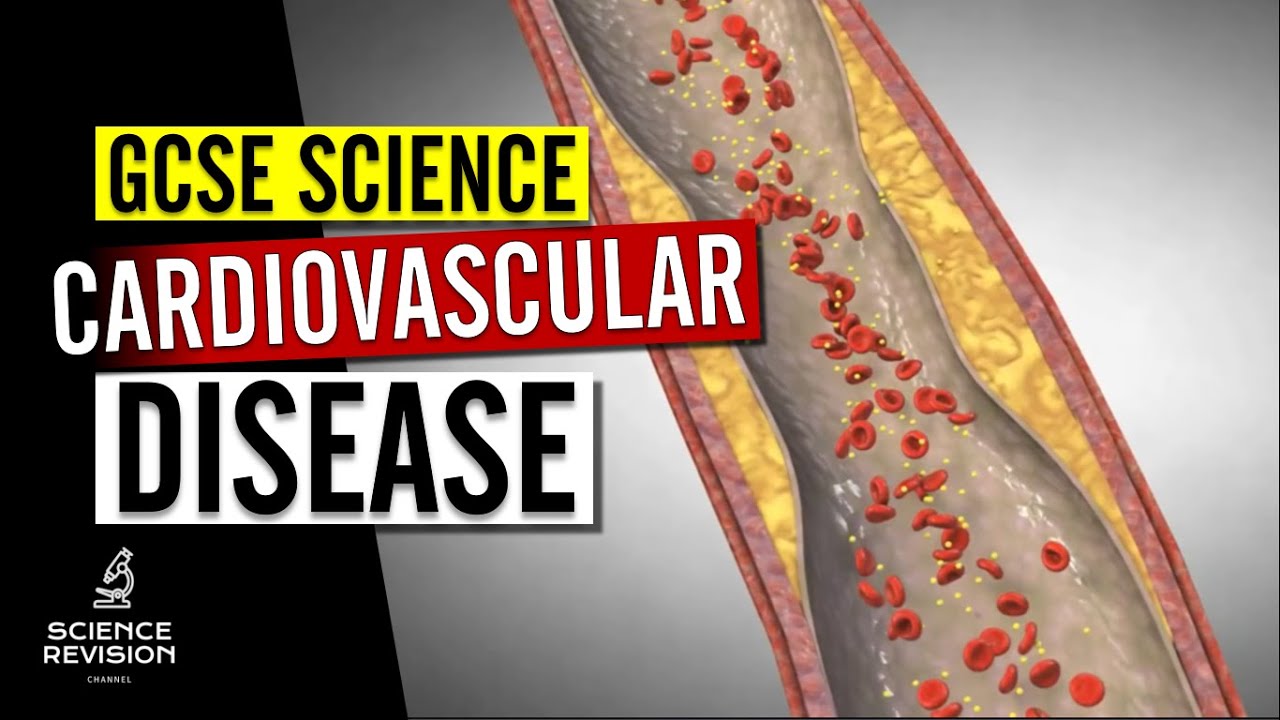 GCSE Science Biology (9-1) – Сердечно-сосудистые заболевания и их лечение