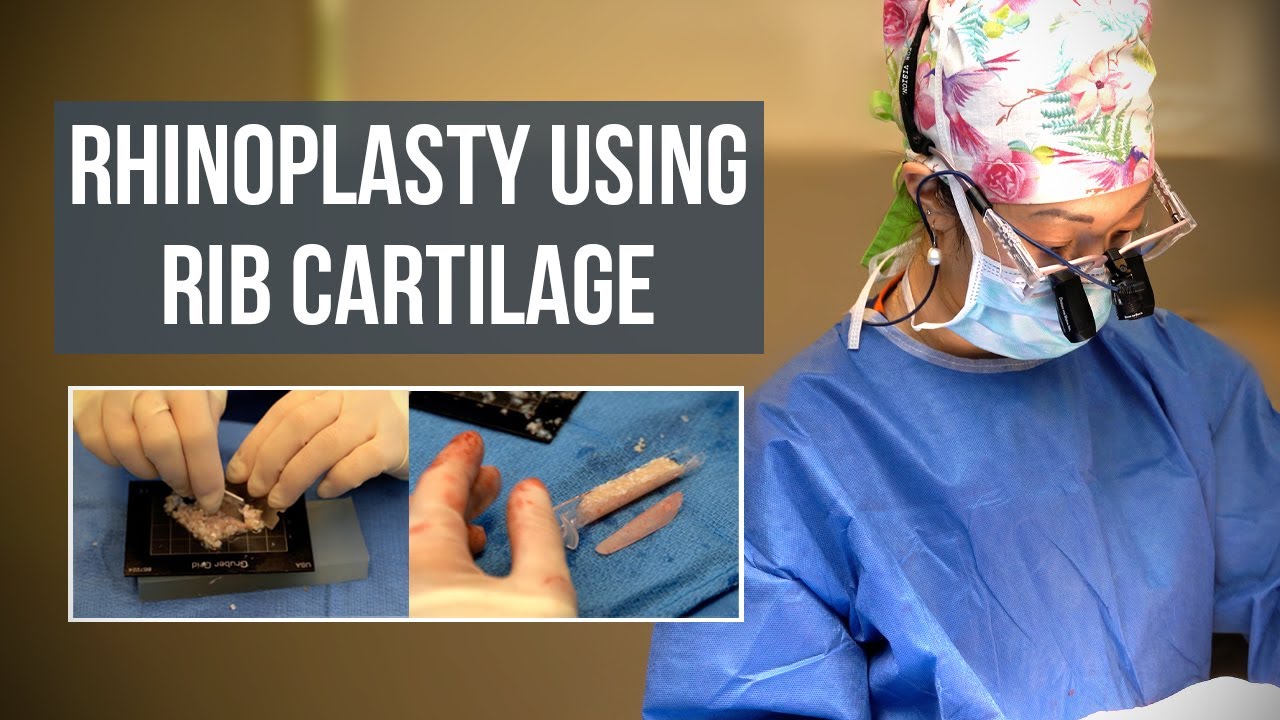 Diced Rib Cartilage with TISSEEL Glue in Rhinoplasty - Dr. Lexie Wang | West End Plastic Surgery
