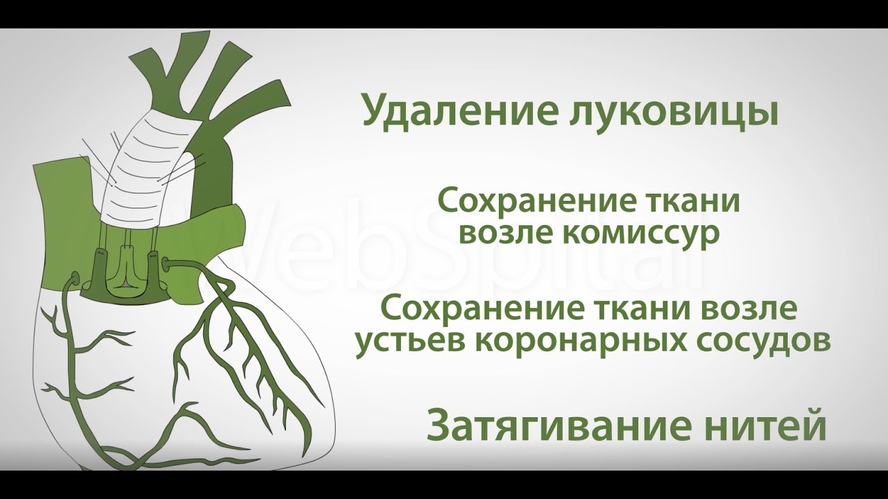 Недостаточность аортального клапана (операция Давида)