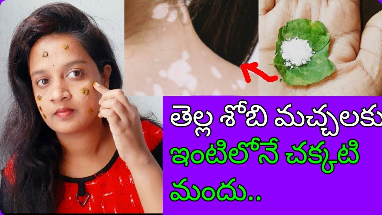 తెల్ల మచ్చలకు చక్కటి మందు | Remedy For Tella Machalu | How To Remove White Spots | Bolli Machalu