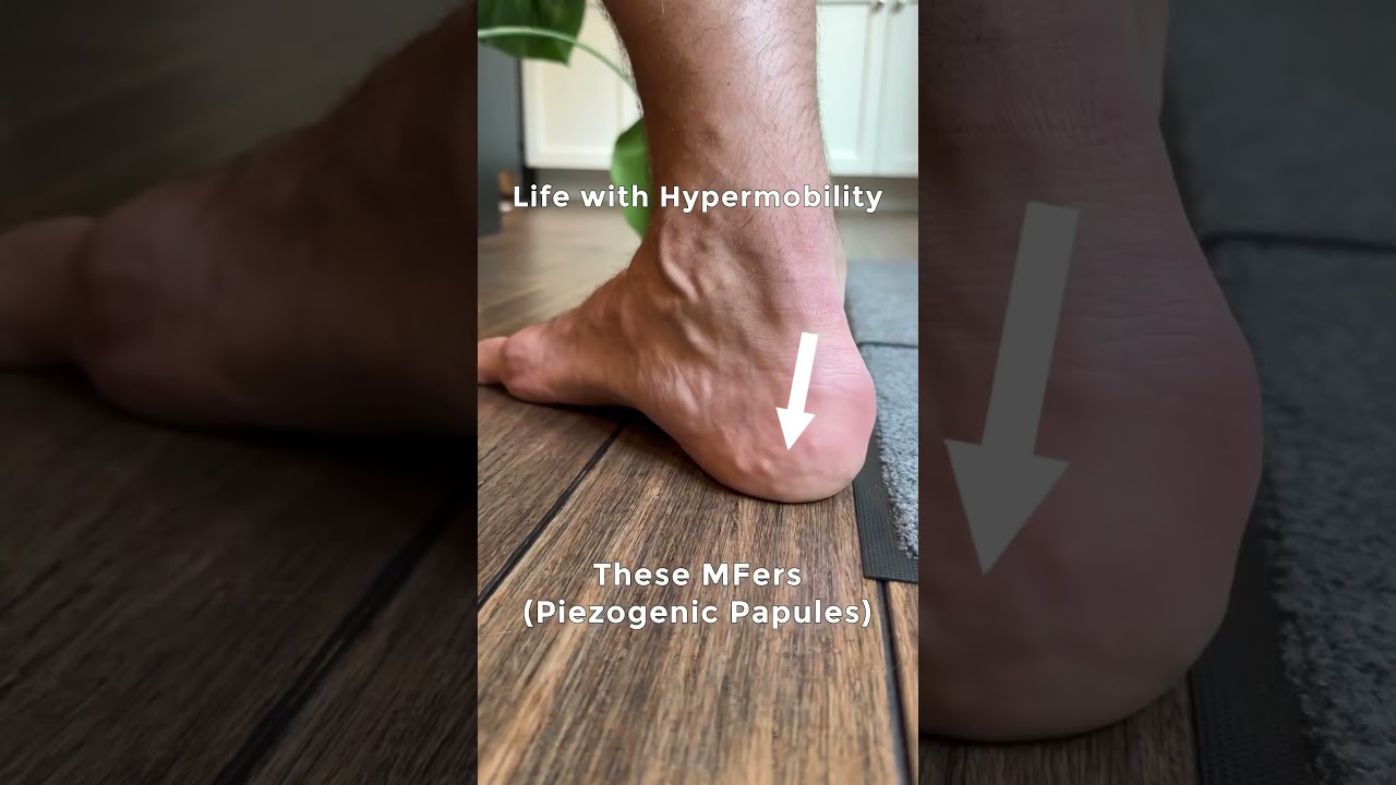Life with hypermobility and Ehlers Danlos related symptoms #flexibility