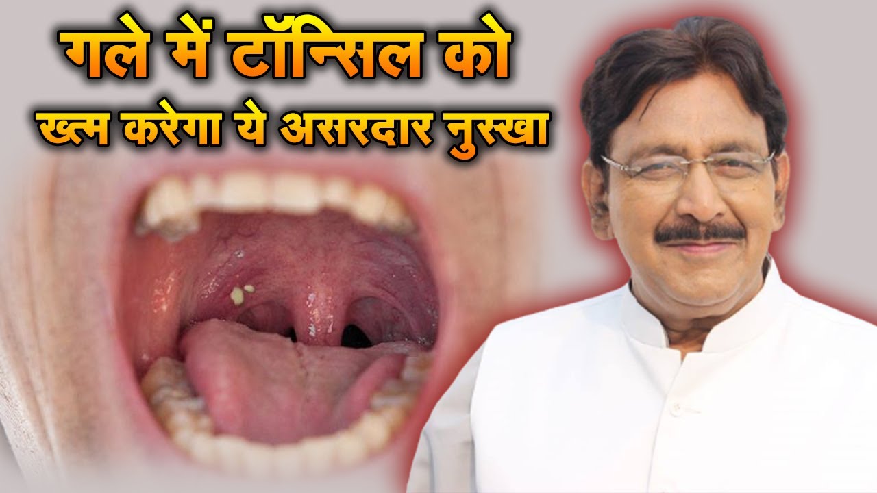 गले में टॉन्सिल को खत्म करेगा ये असरदार नूस्खा | Hakim Suleman Khan | Ishwar TV