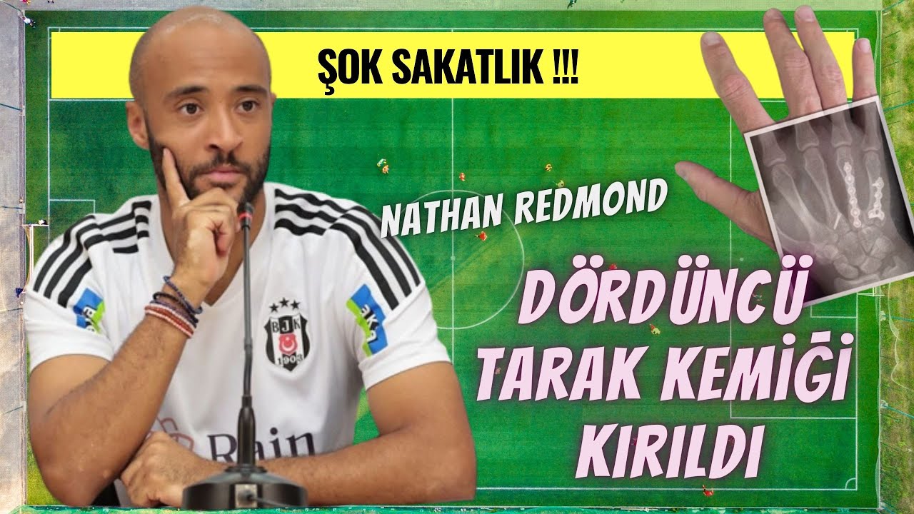 Boksör Kırığı (El Tarak Kemiği - Metakarp) Nedir? 👉🏻 Derbi Öncesi Beşiktaş'ta Redmond Şoku #beşiktaş