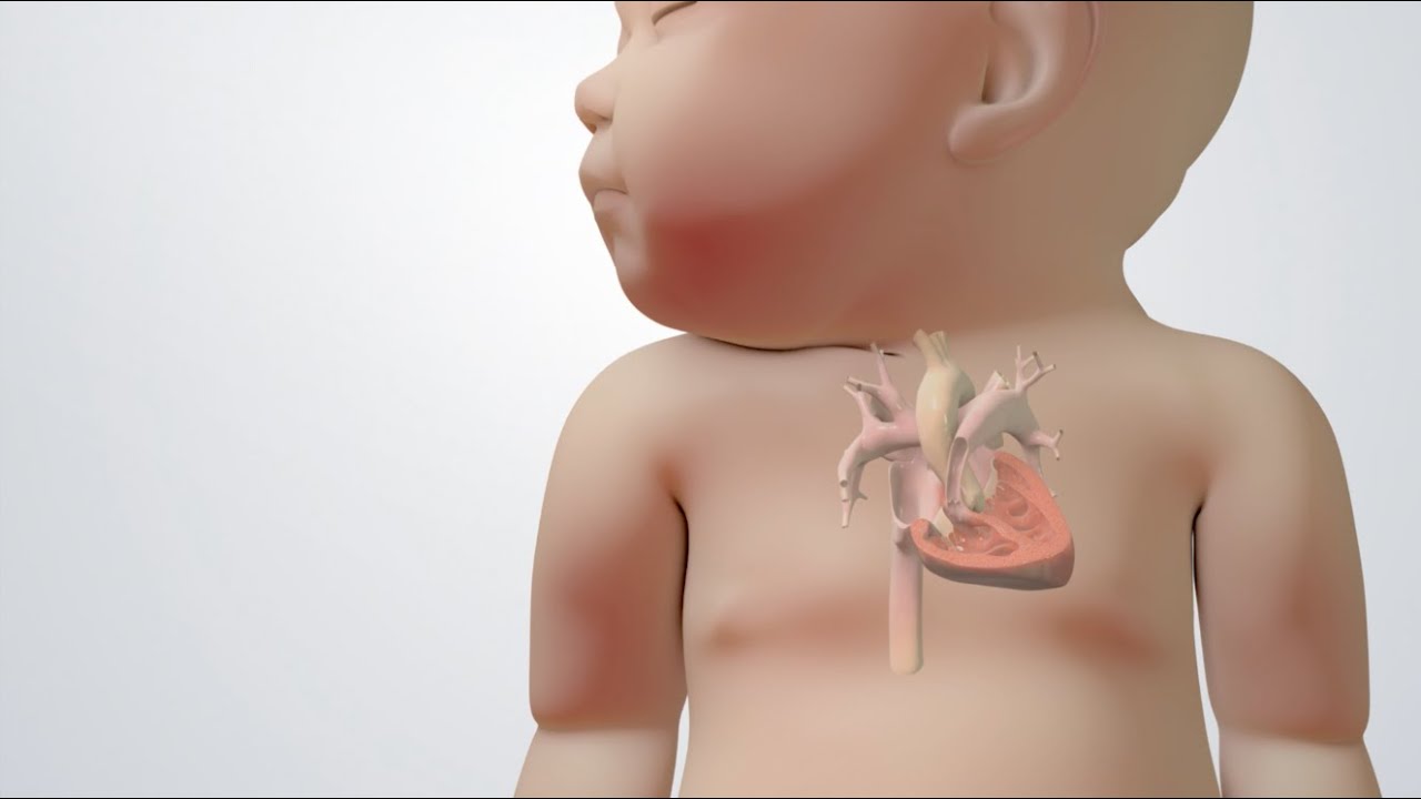 Blue Baby Heart Defect: Tetralogy of Fallot Treatments