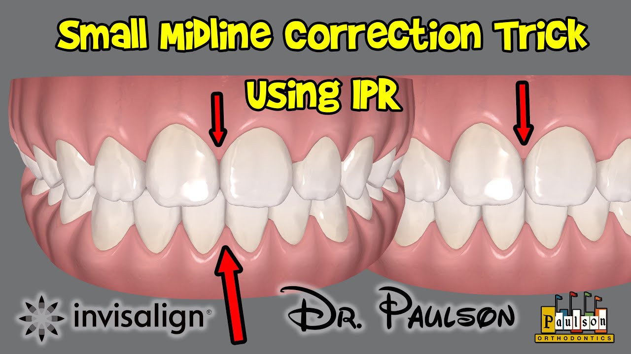 Midline Trick using IPR and Invisalign - Paulson Orthodontics
