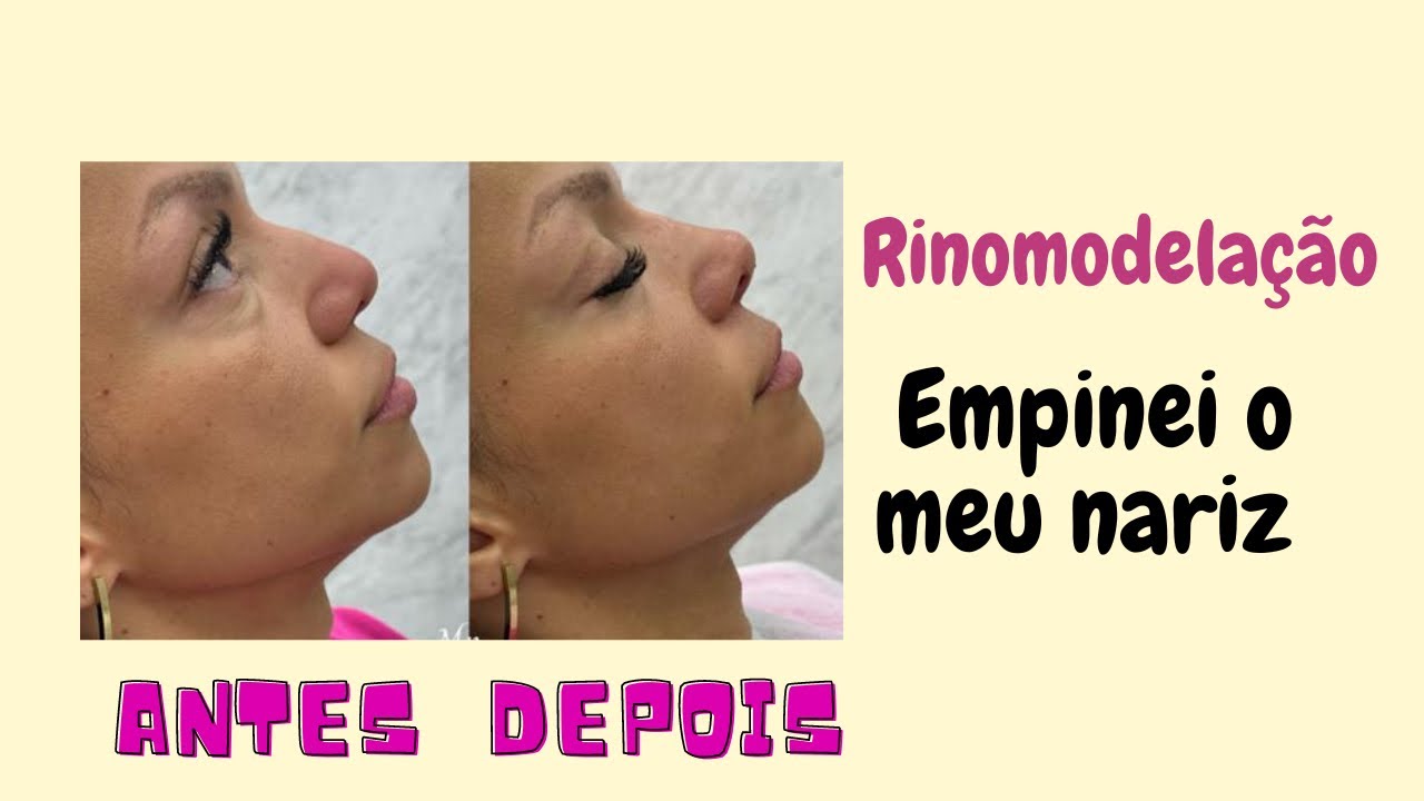 Minha Rinomodelação com ácido hialurônico