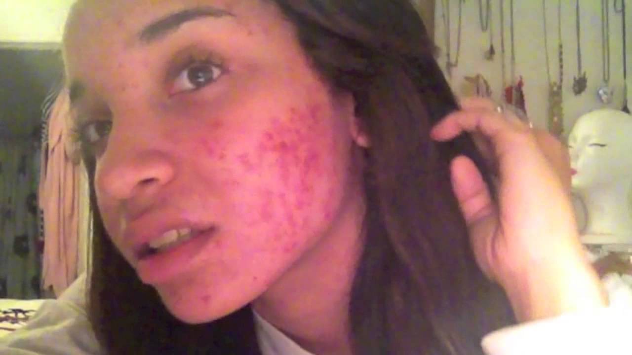 My Acne Journey 2012-13 (Severe Cystic Acne) | RAVEN ELYSE