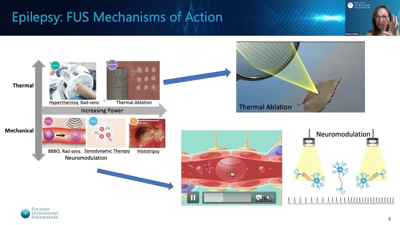Focused Ultrasound and Epilepsy