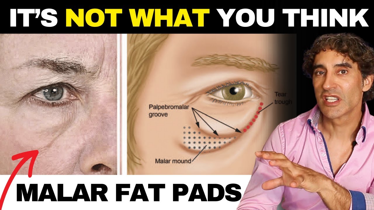 10 Ways to Remove Malar Bags and Festoons