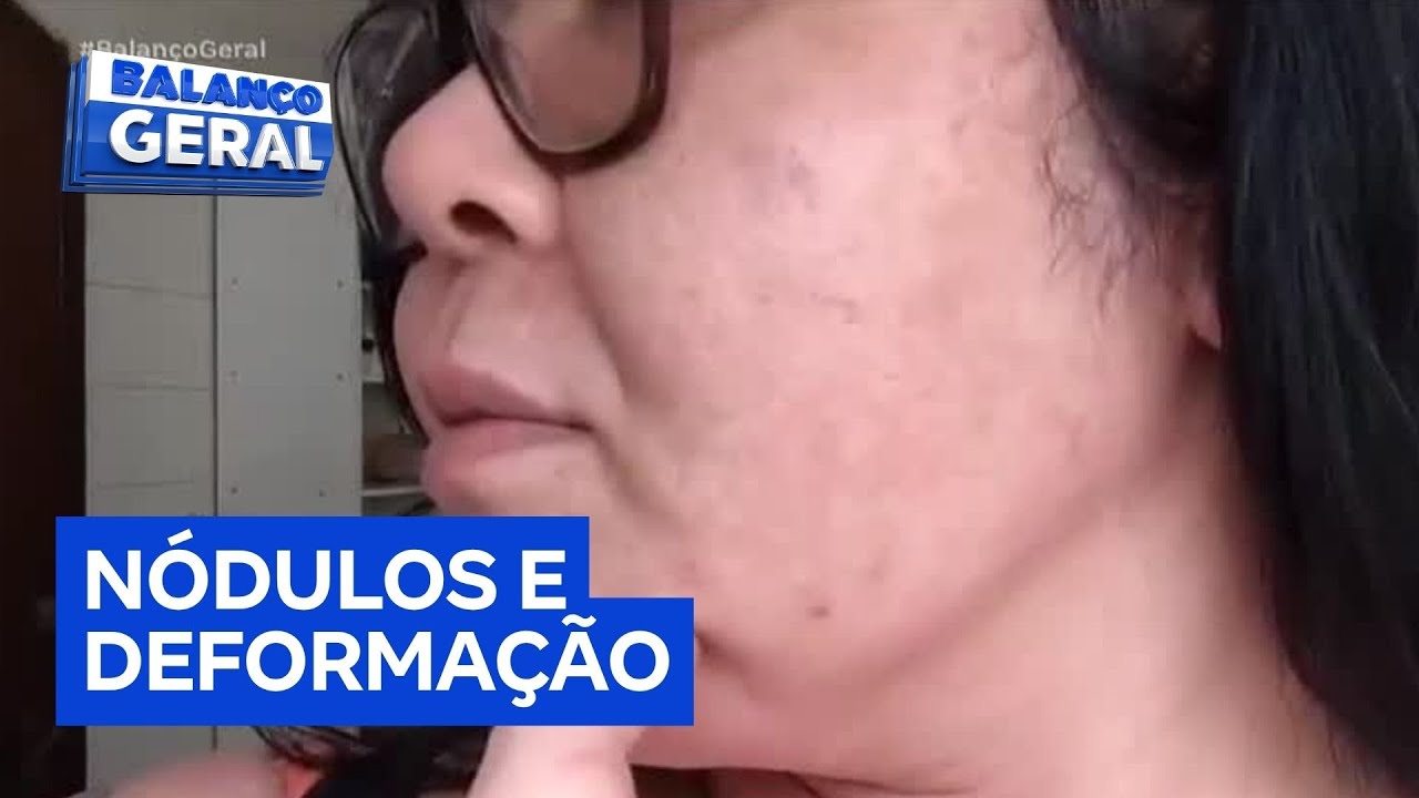 Modelo faz procedimento para deixar rosto mais firme e agora sofre com dores e assimetria facial