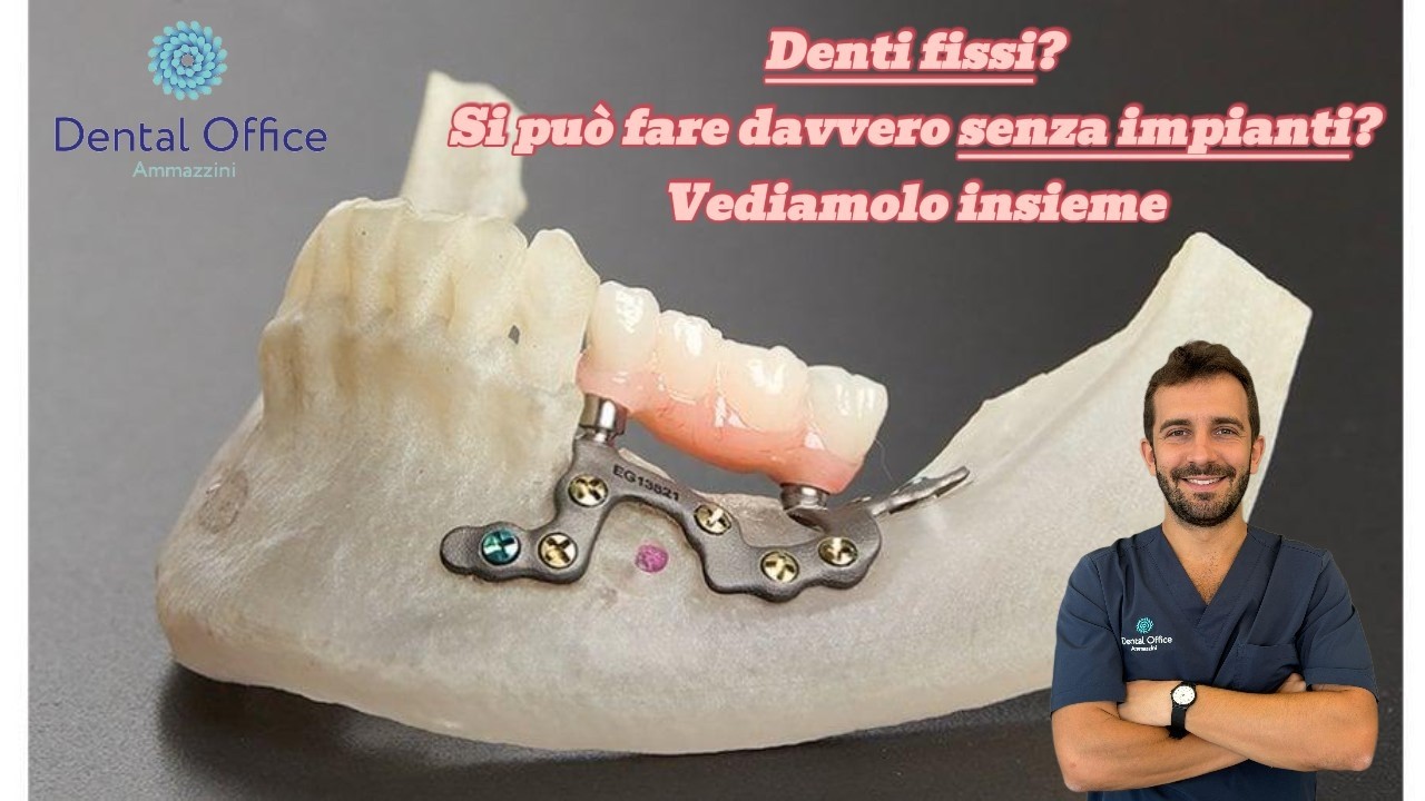 IMPIANTI SENZA VITI? Ecco TUTTO quello che c'è da sapere!!