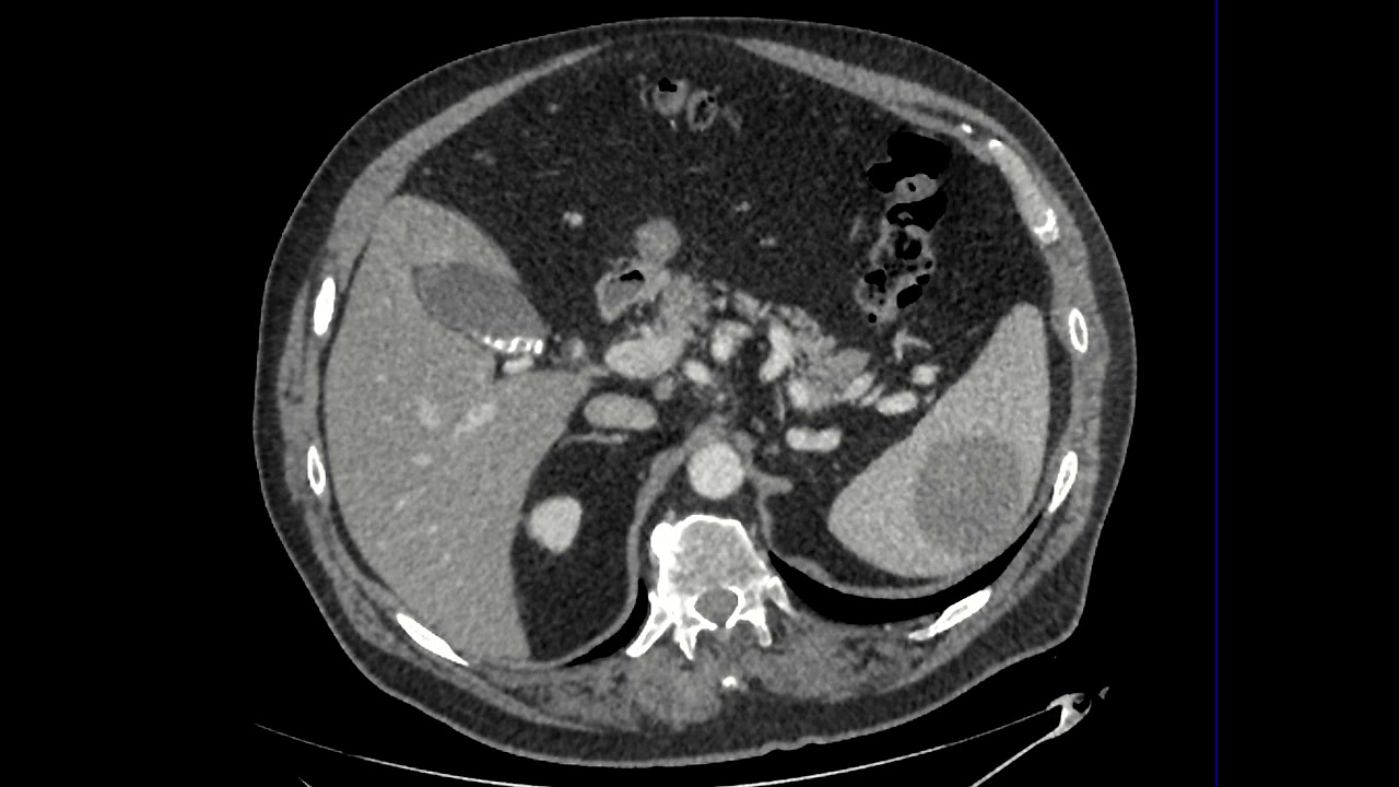 Splenic lymphoma on CT