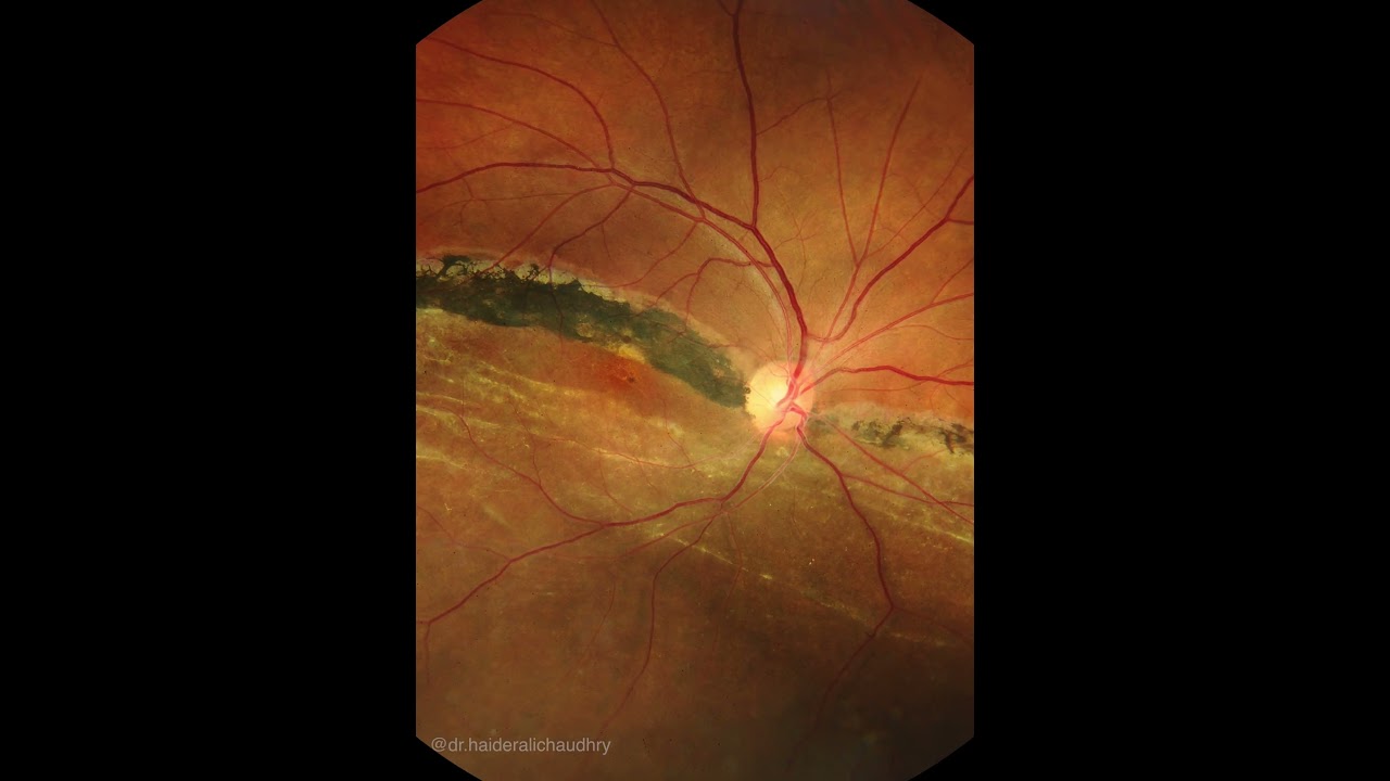 CHRONIC INFERIOR RETINAL DETACHMENT, MACULA OFF, HIGH WATER MARKS