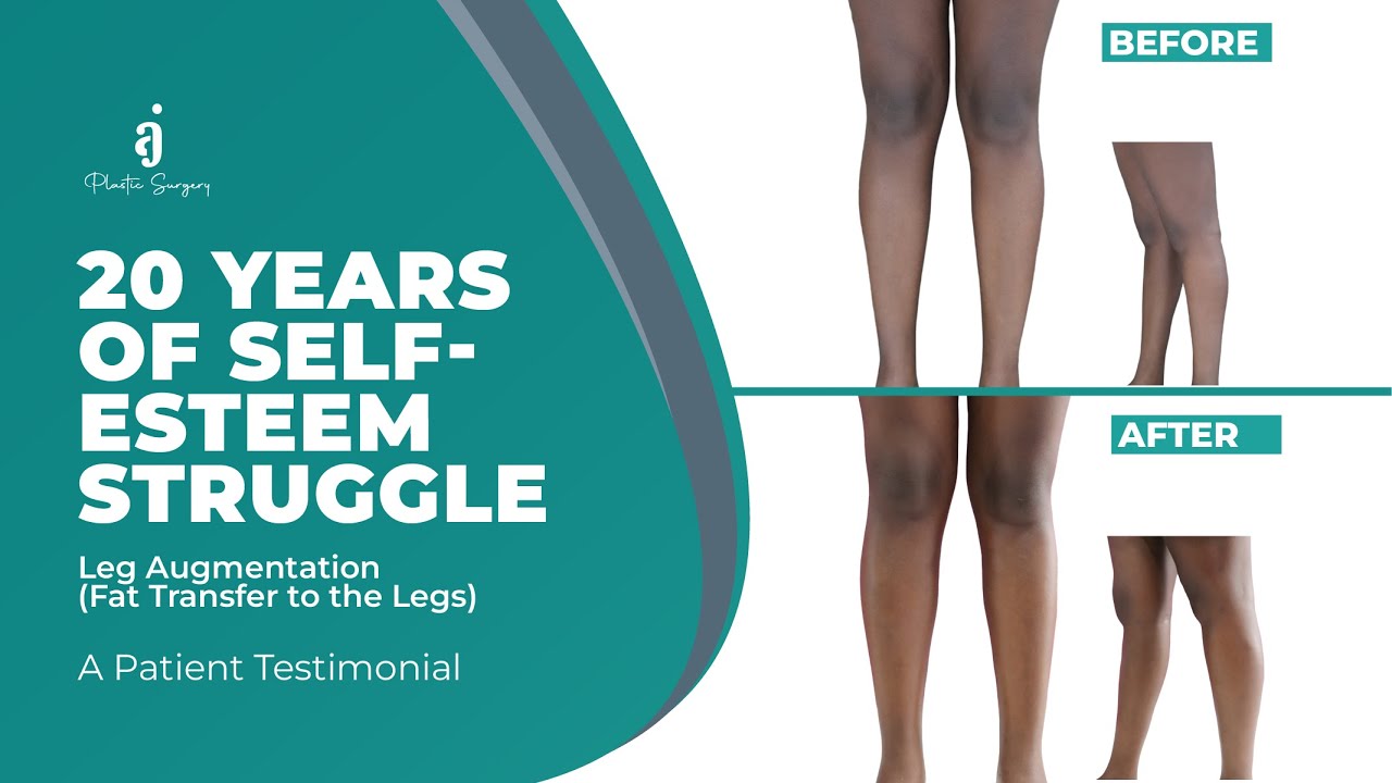 LEG AUGMENTATION (FAT TRANSFER TO THE LEGS)