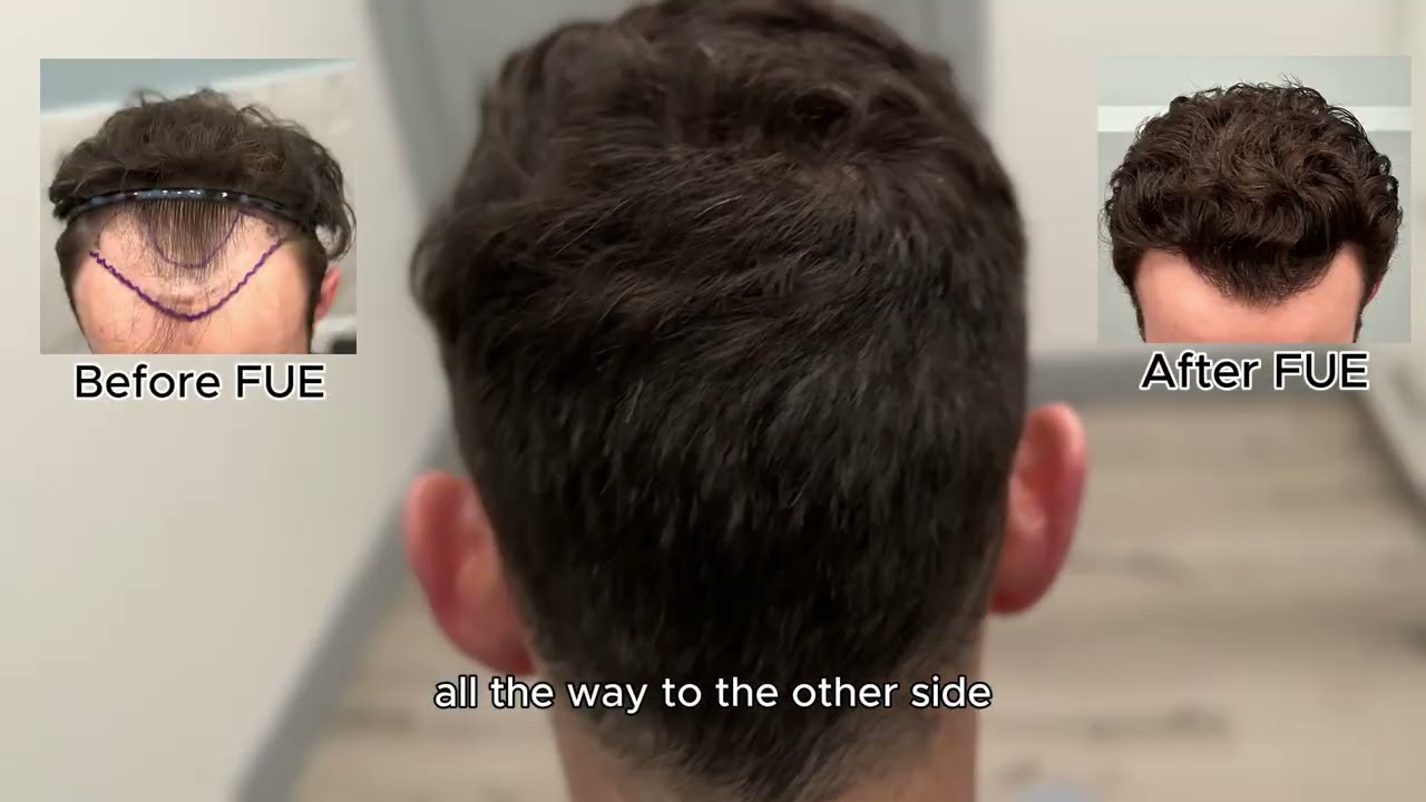 Evaluation of the Donor Areas After Hair Transplantation (6-Case Presentation)- Dr. Sean Behnam