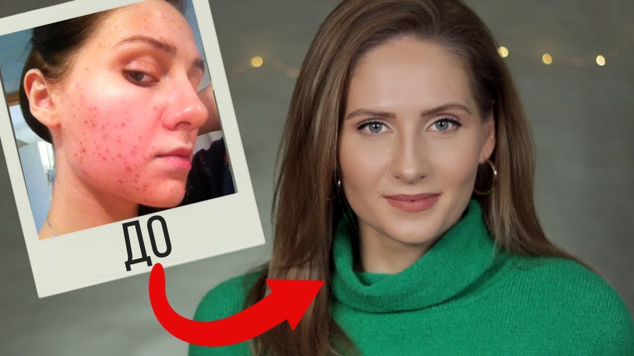 Как избавиться от акне? || ВАМ НУЖНО ЭТО ЗНАТЬ о борьбе с комедонами