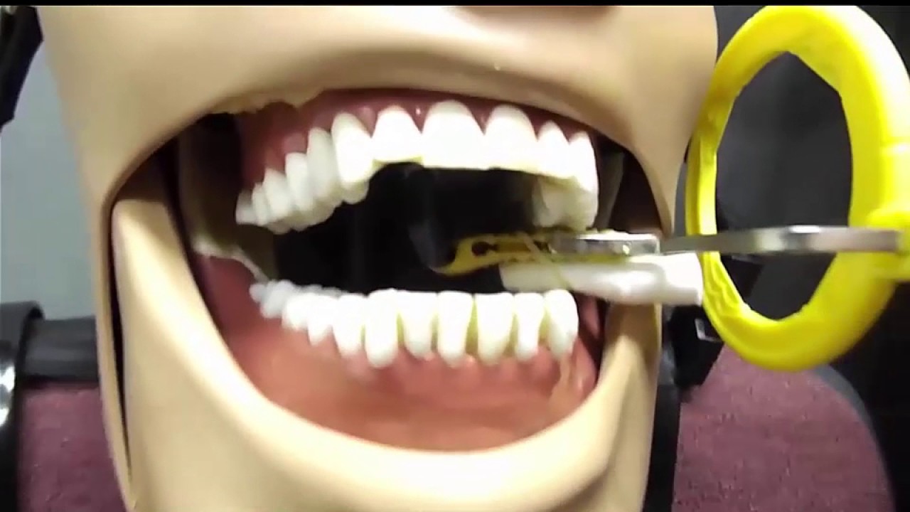 Posterior Periapical Maxillary Placement 8 2 16