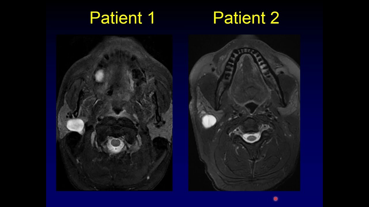 Head to Head: Parotid Mass