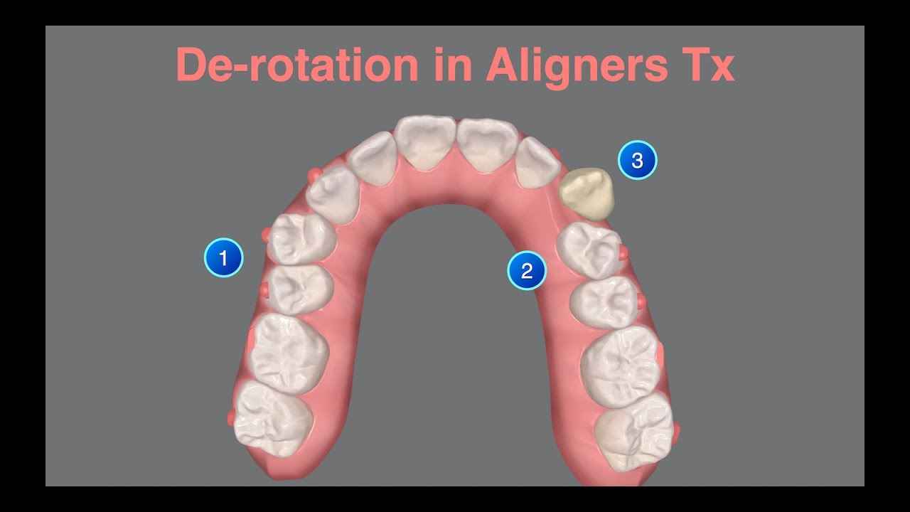 De-rotation in Aligners Tx｜【Chris Chang Ortho】CC761
