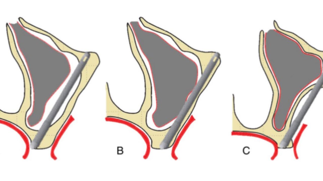 Dental zygomatic implants - ZOF classification