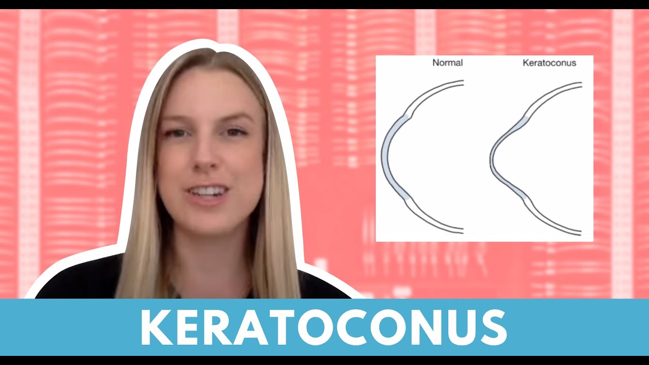 Keratoconus: Understanding, Diagnosing, and Treating a Progressive Corneal Condition