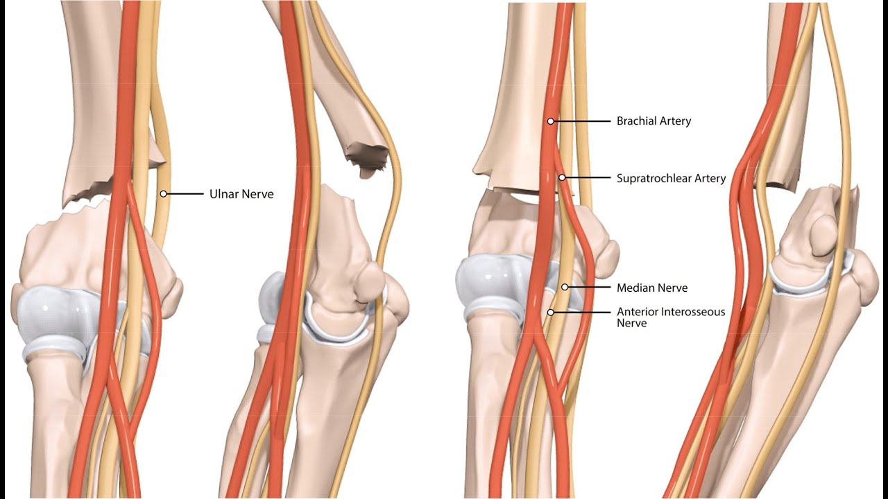 Supracondylar Fracture; break in the distal humerus just above the condyles