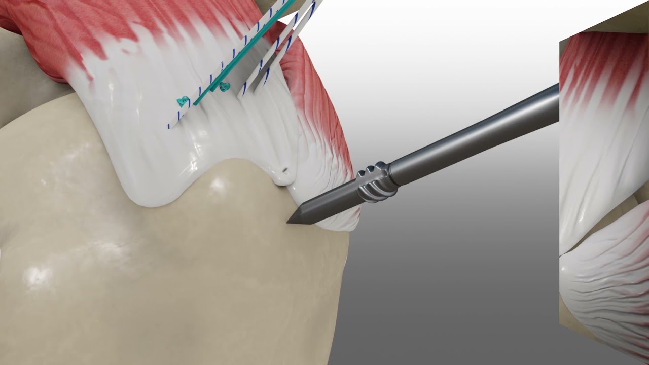 Rotator Cuff Repair