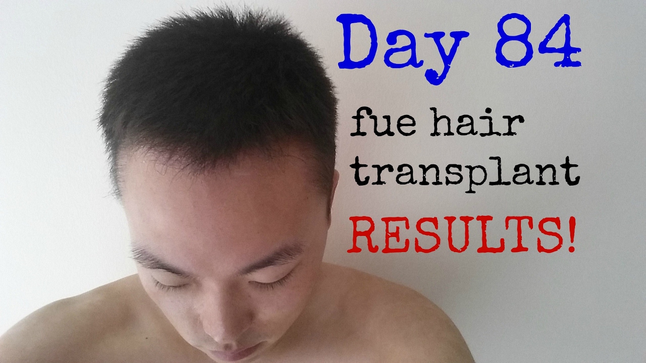 FUE Hair Transplant Results Before and After - Day 84 Post Op