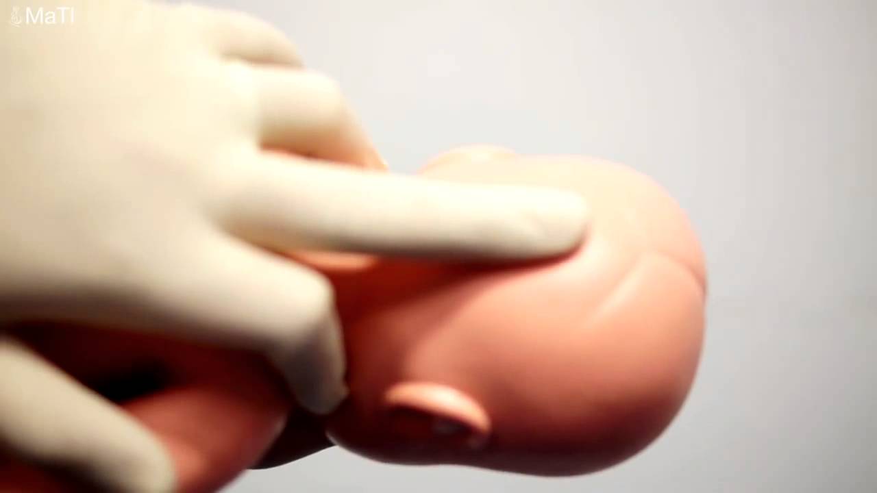 Vaginal Breech Delivery. Skills Training